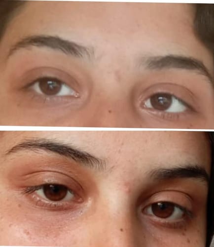 Eye Roller | Eliminates Dark Circles & Puffy Eyes