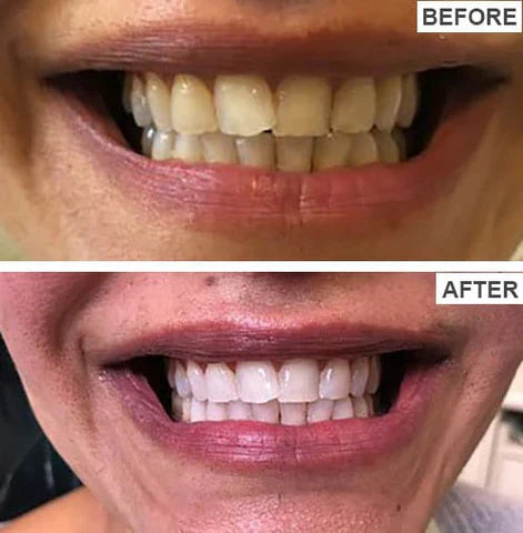 HiSmile V34 Teeth Whitening Serum